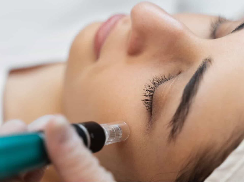 Microneedling Behandlung bei Aestheticbeauty in Nürnberg und Feuchtwangen
